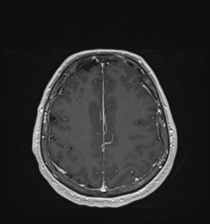 Neurofibromatosis type 2 (Radiopaedia 79097-92049 Axial T1 C+ 150).jpg