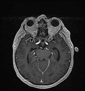 Neurofibromatosis type 2 (Radiopaedia 79097-92049 Axial T1 C+ 85).jpg