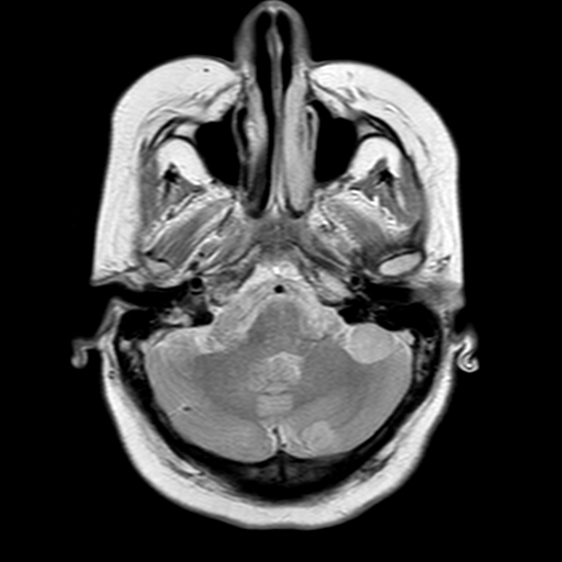 File:Neurofibromatosis type 2 (Radiopaedia 8713-9518 Axial Gradient Echo 20).jpg