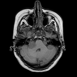 File:Neurofibromatosis type 2 (Radiopaedia 8713-9518 Axial T1 19).jpg