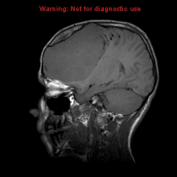 File:Neurofibromatosis type 2 (Radiopaedia 8953-9730 Sagittal T1 14).jpg