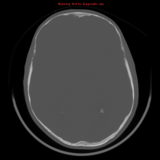 File:Neurofibromatosis type 2 (Radiopaedia 8953-9732 Axial bone window 19).jpg