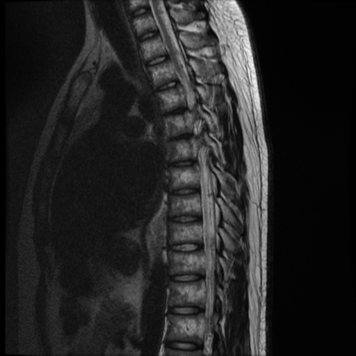 File:Neurofibromatosis type 2 (spinal manifestations) (Radiopaedia 53943-60070 C 6).png