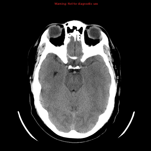 File:Neuroglial cyst (Radiopaedia 10713-11185 Axial non-contrast 21).jpg