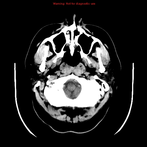 File:Neuroglial cyst (Radiopaedia 10713-11185 Axial non-contrast 30).jpg