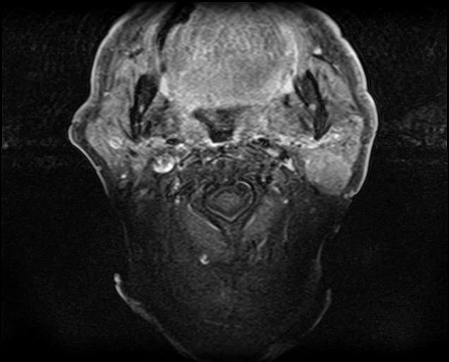 File:Non-Hodgkin lymphoma - parotid gland (Radiopaedia 71531-81890 Axial T1 C+ fat sat 12).jpg