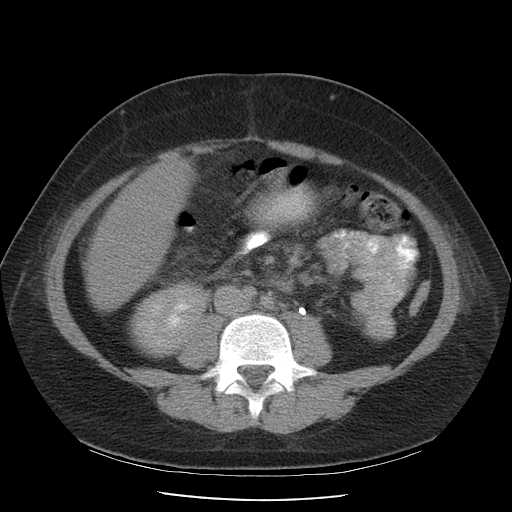 File:Non-Hodgkin lymphoma involving pelvis (Radiopaedia 21281-21197 B 37).jpg