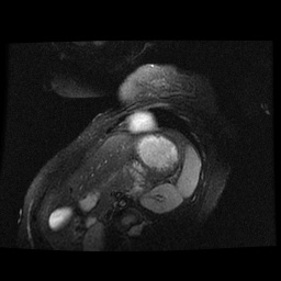 File:Non-compaction of the left ventricle (Radiopaedia 38868-41062 D 1).jpg