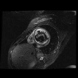 File:Non-compaction of the left ventricle (Radiopaedia 38868-41062 D 9).jpg