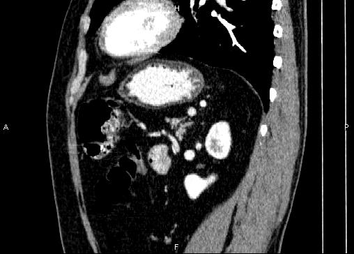 Non-syndromic pancreatic endocrine tumor (Radiopaedia 86958-103178 E 71).jpg