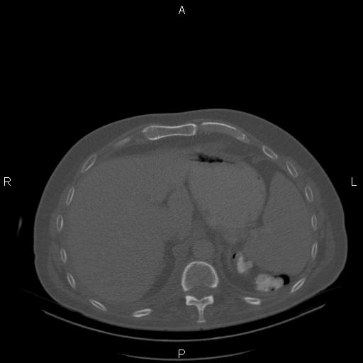 Non Hodgkin lymphoma in a patient with ankylosing spondylitis (Radiopaedia 84323-99624 Axial bone window 27).jpg