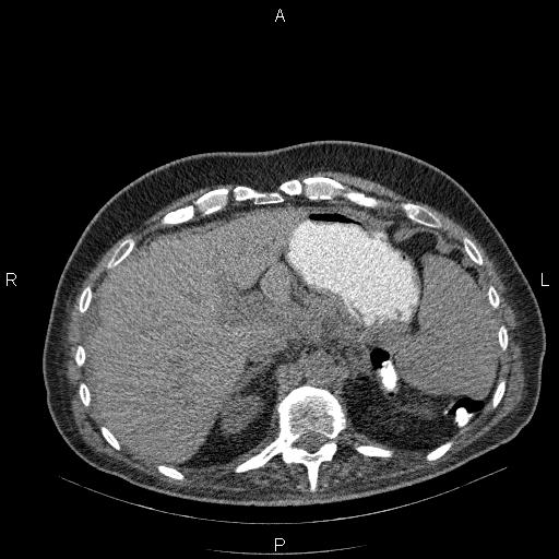 File:Non Hodgkin lymphoma in a patient with ankylosing spondylitis (Radiopaedia 84323-99624 Axial non-contrast 32).jpg