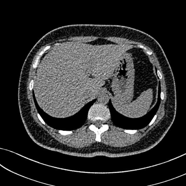 Normal CT chest- adult female (Radiopaedia 52522-58428 Axial non-contrast 119).jpg