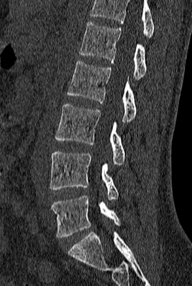 File:Normal CT lumbar spine (Radiopaedia 53981-60118 Sagittal bone window 56).jpg