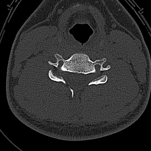 File:Normal CT of the cervical spine (Radiopaedia 53322-59305 Axial bone window 159).jpg