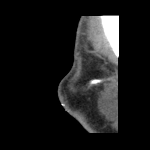 Normal CT paranasal sinuses (Radiopaedia 42286-45390 F 13).jpg