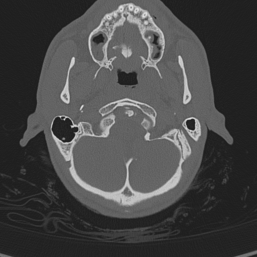 Normal CT skull (Radiopaedia 40798-43459 A 16).png