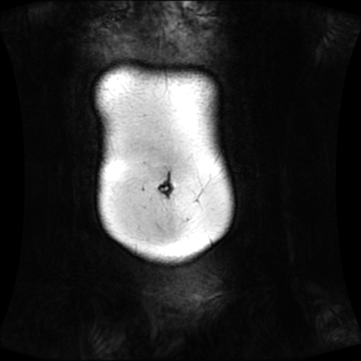 Normal MRI abdomen in pregnancy (Radiopaedia 88001-104541 N 18).jpg