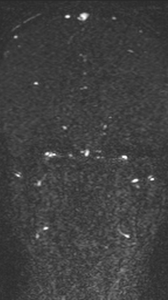 Normal MRI brain with MRV- teenager (Radiopaedia 49425-54553 Coronal MRV 135).jpg