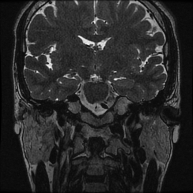 Normal MRI petrous (Radiopaedia 91317-108949 Coronal T2 30).jpg