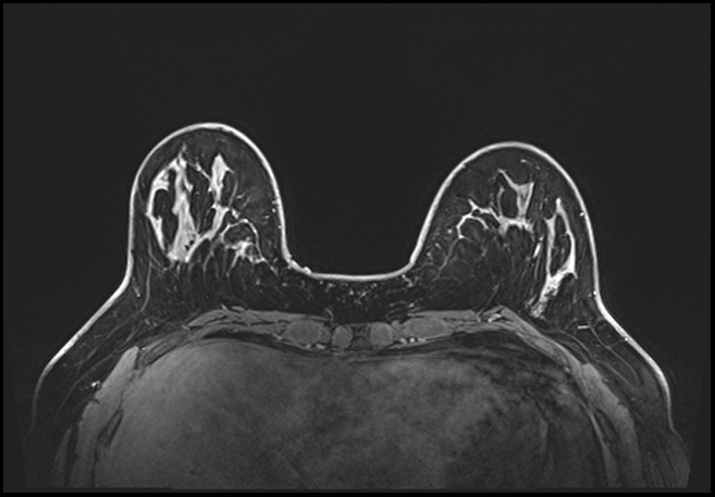 Normal breast MRI - dense breasts (Radiopaedia 80454-93850 C 63).jpg