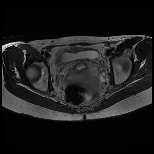 File:Normal female pelvis MRI (retroverted uterus) (Radiopaedia 61832-69933 Axial T2 19).jpg