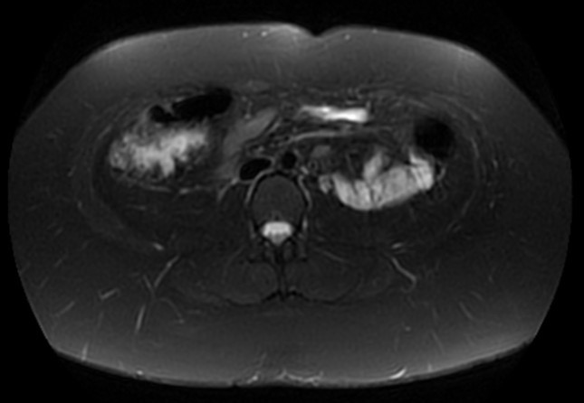 File:Normal liver MRI with Gadolinium (Radiopaedia 58913-66163 Axial T2 fat sat 9).jpg