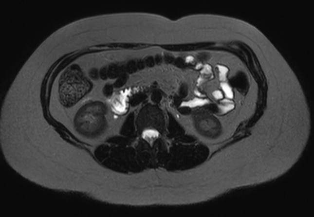 File:Normal liver MRI with Gadolinium (Radiopaedia 58913-66163 E 8).jpg