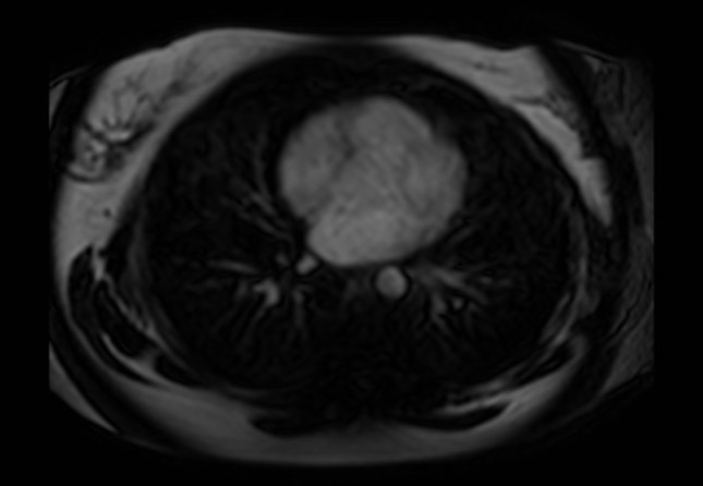 Normal liver MRI with Gadolinium (Radiopaedia 58913-66163 J 90).jpg