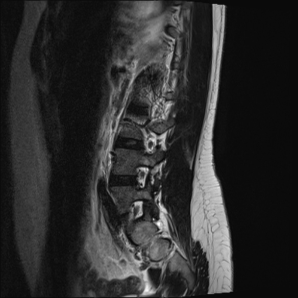 File:Normal lumbar spine MRI- 3 T (Radiopaedia 53280-59250 Sagittal T2 19).jpg