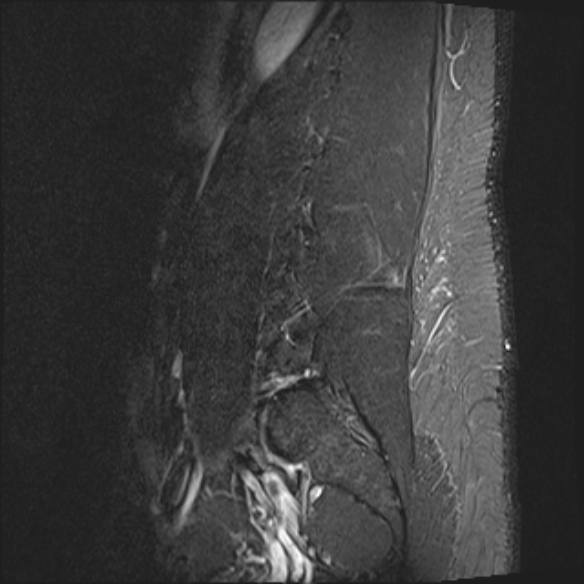File:Normal lumbar spine MRI (Radiopaedia 47857-52609 Sagittal STIR 1).jpg