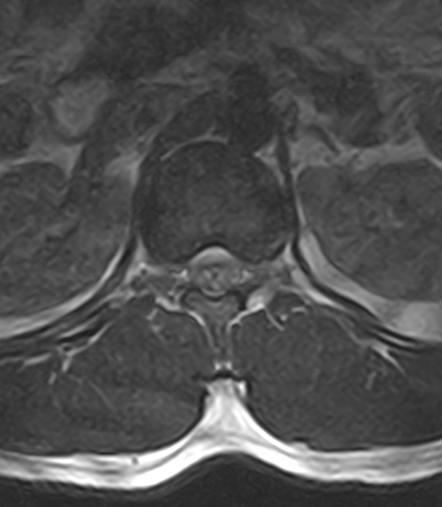 Normal lumbar spine MRI - low-field MRI scanner (Radiopaedia 40976-43699 Axial T2 17).jpg
