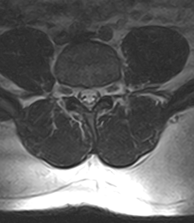 Normal lumbar spine MRI - low-field MRI scanner (Radiopaedia 40976-43699 Axial T2 71).jpg