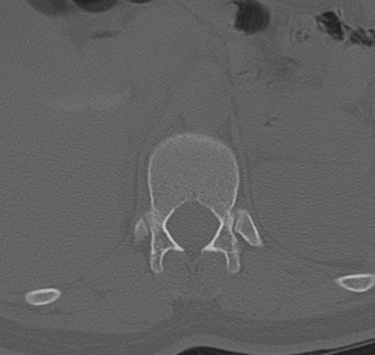 File:Normal lumbosacral CT (Radiopaedia 37923-39867 Axial bone window 21).png