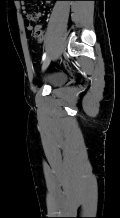 Normal pelvis CT angiogram (Radiopaedia 84966-100481 C 41).jpg