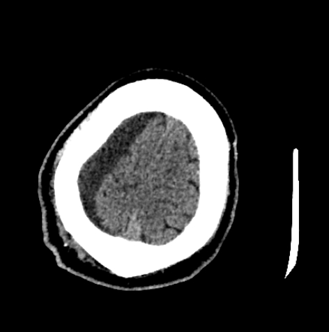 Normal pressure hydrocephalus (Radiopaedia 73685-84479 Axial non-contrast 72).jpg
