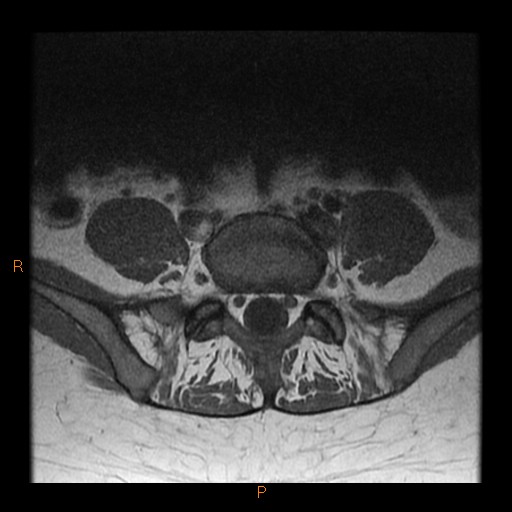 File:Normal spine MRI (Radiopaedia 77323-89408 Axial T1 23).jpg