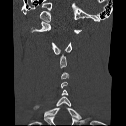File:Normal trauma cervical spine (Radiopaedia 41017-43760 Coronal bone window 29).png