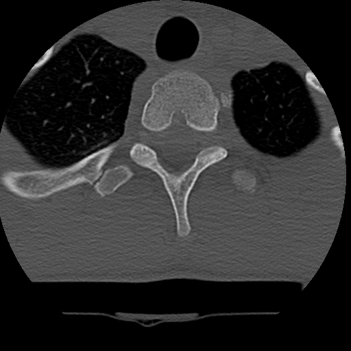 Normal trauma spine imaging (age 16) (Radiopaedia 45335-49358 Axial bone window 82).jpg