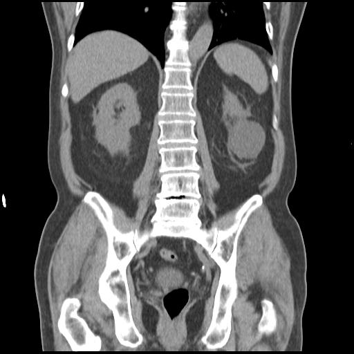 Obstructing renal calculus (Radiopaedia 29517-30016 Coronal non-contrast 37).jpg