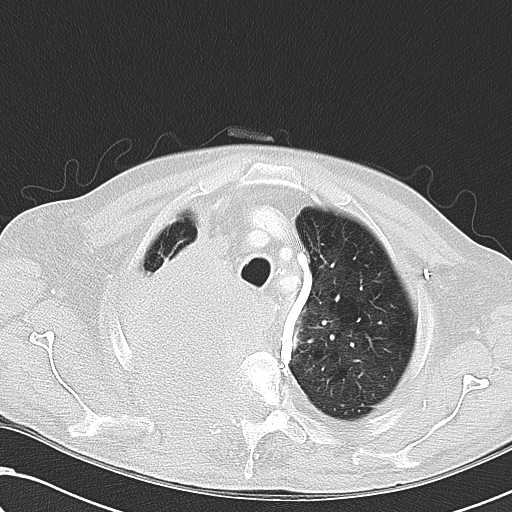 File:Obstructive superior vena cava tumor thrombus (Radiopaedia 28046-28306 Axial lung window 12).jpg