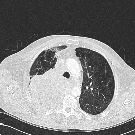 File:Obstructive superior vena cava tumor thrombus (Radiopaedia 28046-28306 Axial lung window 17).jpg