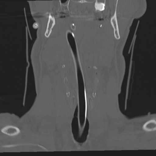File:Occipital condyle fracture (Radiopaedia 33467-34517 Coronal bone window 3).png