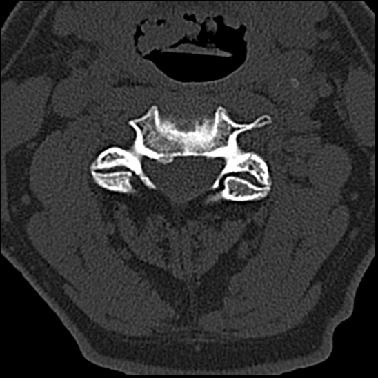 Occipital condyle fracture (type 1) (Radiopaedia 87670-104084 Axial bone window 36).jpg