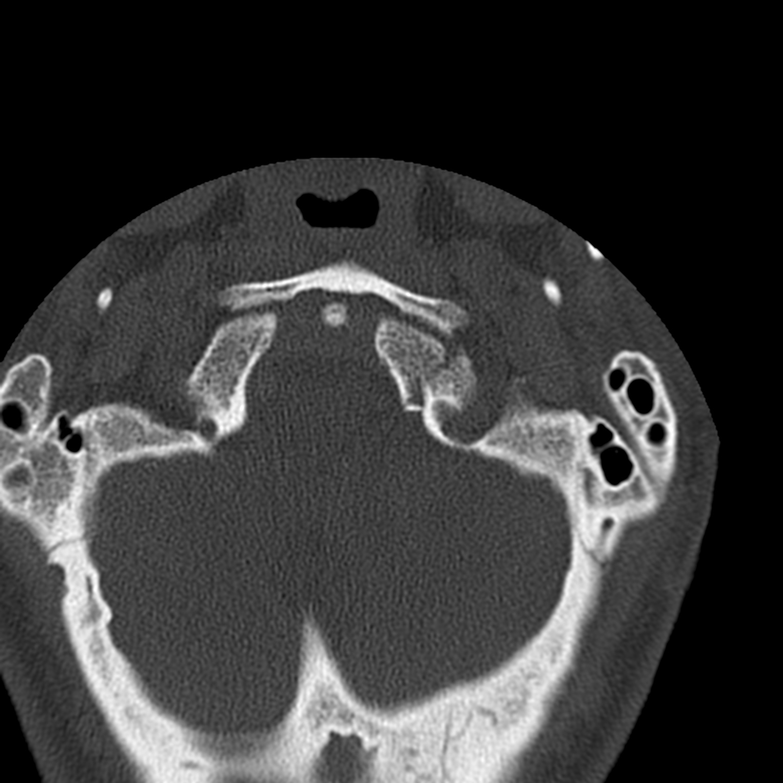 Occipital Condyle Fracture Radiopaedia 31755 32691 Axial Bone Window Nc Commons 0697