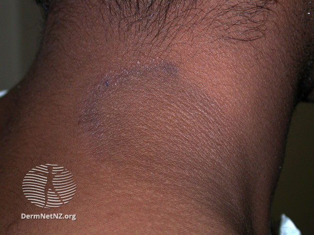 File:(DermNet NZ dermatitis-lichen-simplex-3116).jpg