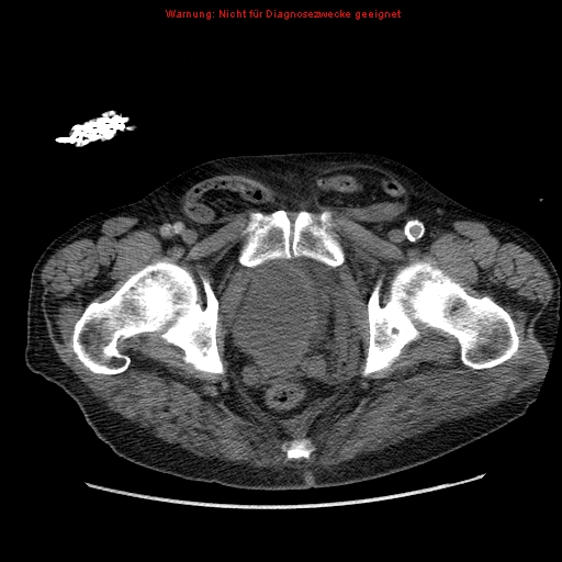 File:Abdominal aortic aneurysm- extremely large, ruptured (Radiopaedia 19882-19921 Axial C+ arterial phase 78).jpg
