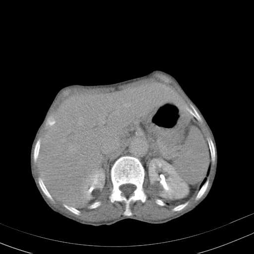 File:Abdominal aortic aneurysm (Radiopaedia 20827-20742 Axial C+ delayed 6).jpg