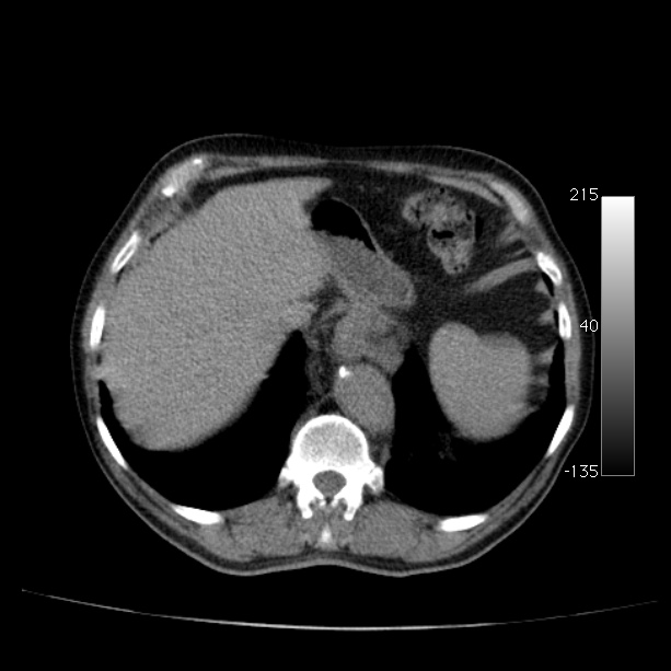 Abdominal aortic aneurysm (Radiopaedia 29248-29660 Axial non-contrast 12).jpg