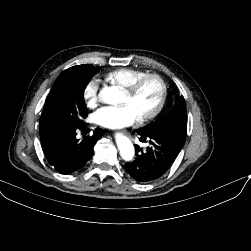 File:Abdominal aortic aneurysm (Radiopaedia 67117-76452 Axial C+ arterial phase 3).jpg